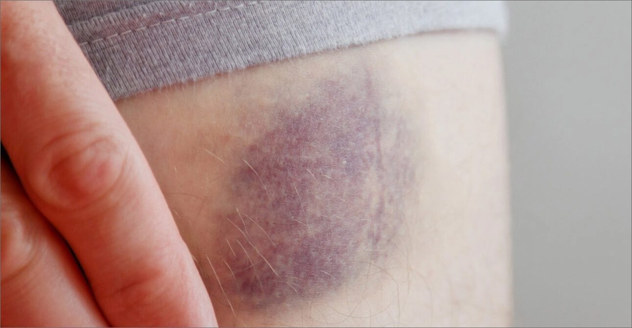 ematoma ecchimosi edema