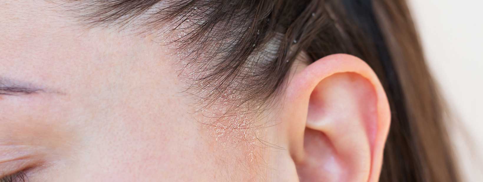 Dermatite seborroica