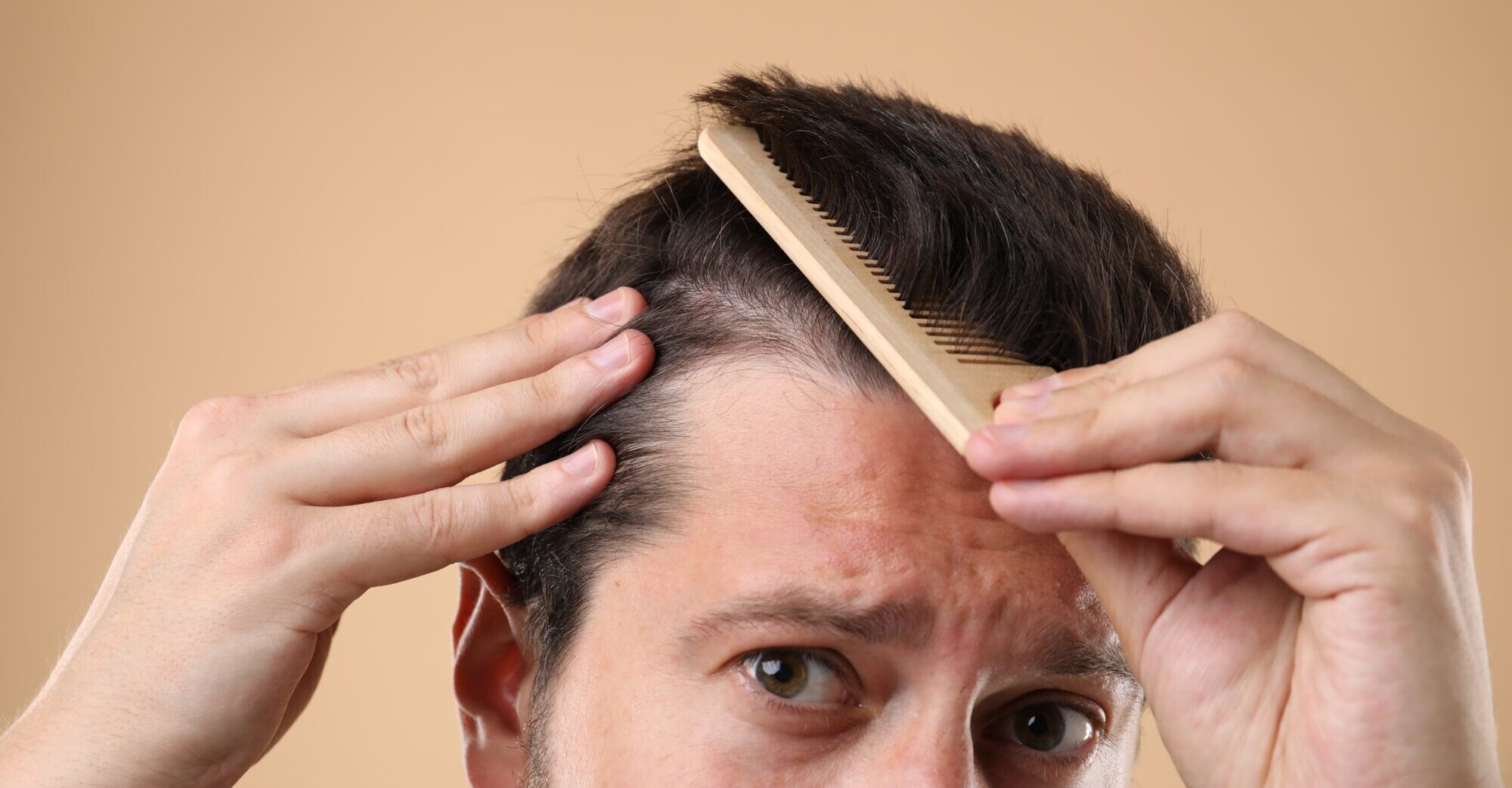 Man brushing his hair on beige background, closeup. Alopecia problem