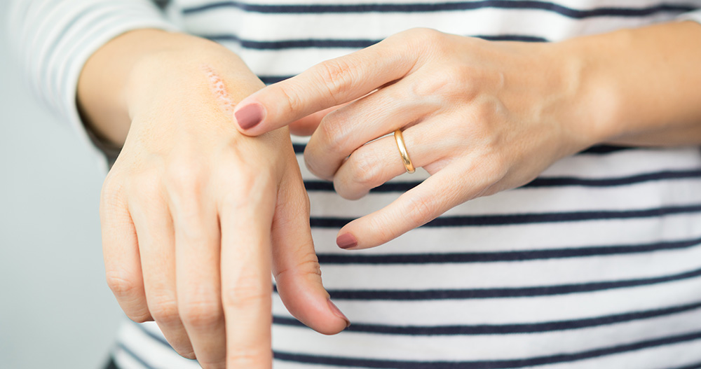Donna con maglietta a righe che sfiora una cicatrice sulla mano